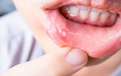 Phải chăng trời nắng nóng xảy ra hiện tượng nhiệt miệng?